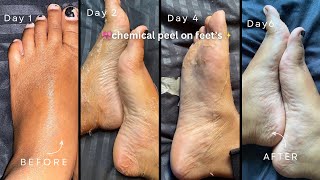 Say hello to your new baby fit with sanfe step into comfort exfoliating foot mask ✨ chemicalpeel [upl. by Ayrb750]