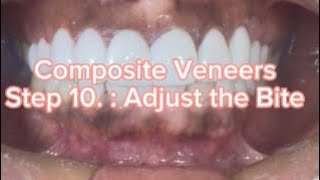 Composite Veneers Step 10 Adjust the Bite [upl. by Dulla]