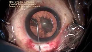 Posterior subcapsular cataract and hydrodissection in Cataract IOL surgery [upl. by Oiled]