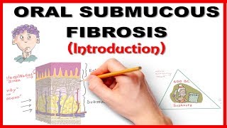 Oral Submucous Fibrosis OSMF Introduction [upl. by Adnim]