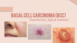 Basal Cell Carcinoma BCC Characterisitics Types Treatment options [upl. by Milstone]