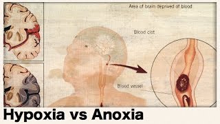 Respiratory  Types of Hypoxia Hypoxemic  Anemic  Stagnant  Histotoxic [upl. by Yuk]