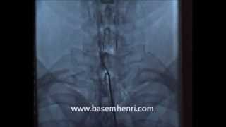 تسليك إلتصاقات القناة العصبية العنقية لعلاج الجراحات السابقة الفاشلة د باسم هنرى CX neuroplasty [upl. by Barthel486]