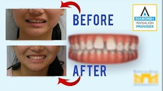 Invisalign Before and After Gap in Teeth [upl. by Yde]