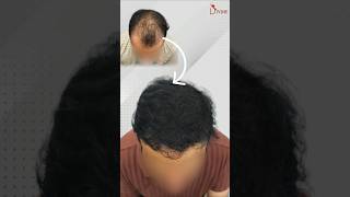 From Hair Loss to Hair Gain 8Month Hair Transplant Journey Restores Confidence 🤯 [upl. by Annaehr]