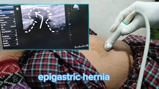 epigastric hernia usg [upl. by Erickson]