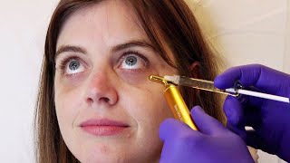 Women With Dark Circles Get UnderEye Injections For The First Time [upl. by Atinram]