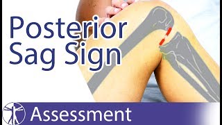 Posterior Sag Sign  Posterior Cruciate Ligament Tear [upl. by Nevai]