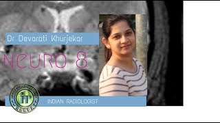 TMT Neuro Case 8 by Dr Devarati Khurjekar [upl. by Nicholson]