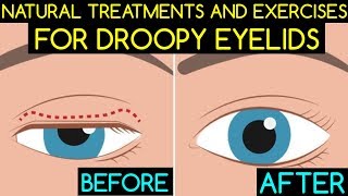 Natural Treatments and Exercises For Droopy Eyelids [upl. by Artemla625]