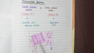 Schwannoma Pathology [upl. by Kisung310]