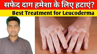 सफेद दाग से हमेशा के लिए छुटकारा पाएं।। Best Treatment For Leucoderma [upl. by Didi]