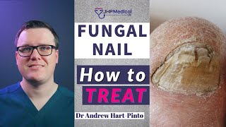 How to TREAT Fungal Nail  Get Rid Of Nail Fungus AntiFungal Lacquer amp Tablets [upl. by Annairoc]