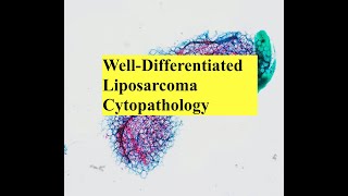 Lipomatous Tumor Cytopathology Interesting Case Conference [upl. by Werra]