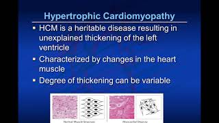 Pediatric Cardiomyopathy 101 [upl. by Repsihw]