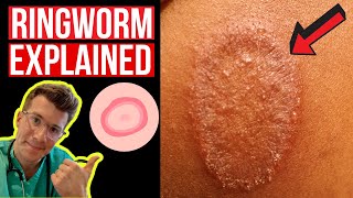 Doctor explains Ringworm aka Tinea including symptoms signs causes and treatment [upl. by Janet617]