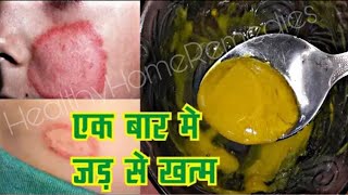 दादखाज खुजली की 2 दिनों में छुट्टी कर देगा  fungal infection treatment  ringworm treatment [upl. by Tinya]