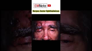 Herpes zoster ophthalmicus [upl. by Erleena]