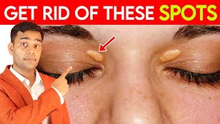 Get Rid Of These Spots  Fat Under Eyes  Xanthelasma  Natural Remedies  Dr Vivek Joshi [upl. by Mossberg]