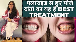 Fastest way to whiten teeth Teeth whitening at home  Teeth whitening strips yellowteeth [upl. by Alyal]