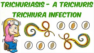 Trichuriasis  A Trichuris trichiura Infection [upl. by Moises]