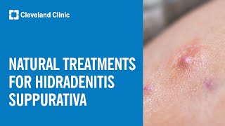 Natural Treatment Options for Hidradenitis Suppurativa [upl. by Fuld]