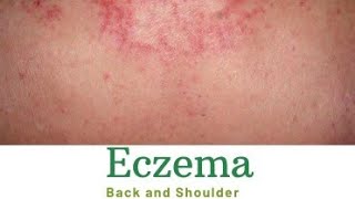 Eczema eczema  skin problem [upl. by Tioneb]