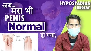 Successful Hypospadias Surgeon in Kolkata  मूत्र का छिद्र सही जगह पर न खुलने की समस्या  Dr Nagwani [upl. by Estas]