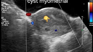 Ultrasound Imaging of Posterior Wall Myometrial Cyst with Adenomyosis Features in a globular Uterus [upl. by Lot]