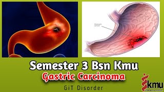 Gastric Carcinoma in pashto  gastric cancer  Gastrointestinal disorder  AHN Kmu Bsn 3 semester [upl. by Weibel]