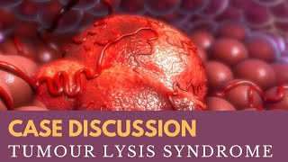 Case Discussion  Tumour Lysis Syndrome [upl. by Yspyg]