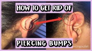 HOW TO GET RID OF PIERCING BUMPS [upl. by Mavis]