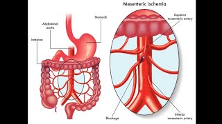 Angioplasty of Superior Mesenteric artery angioplasty stenosis [upl. by Ellerrehc]