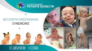 23  Beckwith Wiedemann syndrome BWS [upl. by Ynaffik]