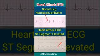 ECG changes During Heart Attack medicine ecg [upl. by Idroj113]