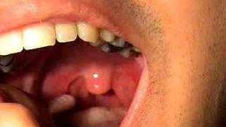 tonsil stones removal tonsillolith removed [upl. by Aronas]