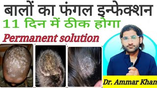 Hairs Balon ka fungal infection ab 11 din me hamesha ke liye thik hoga Hair fungal best cure [upl. by Nahtnanhoj]