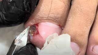 Treatment for Ingrown Toenails 004 satisfying nailsAlphanalis HCM [upl. by Ishmael]