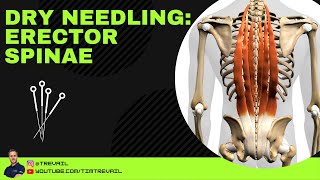 Dry Needling Erector Spinae [upl. by Eekram]