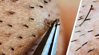 Ingrown hair removal compilation😌 [upl. by Forrer]