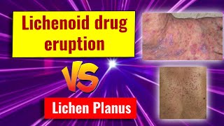 Lichenoid drug eruption features and comparison with lichen planus [upl. by Aizahs]