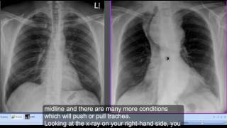 Chest xray Retrosternal Goitre [upl. by Mialliw]