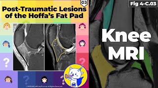 Fig 4C03 Posttraumatic Lesions of Hoffa’s Fat Pad [upl. by Nnairahs]