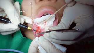 Mucocele removal surgery 입술점액낭종  JUDITH PS KOREA 유디트성형외과 [upl. by Yraunaj]