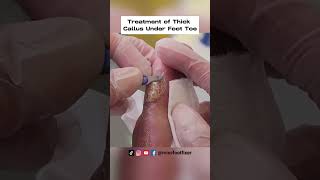 Thick Callus Under Foot Toe Causes Treatment and Prevention [upl. by Leler]