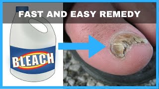 How to Get Rid of Toenail Fungus with Bleach  Toe Fungus Journey [upl. by Lamar]