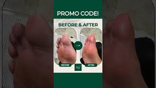 How to Get Rid of Calluses on the Bottom of Your Feet Naturally at Home bestways removethickskin [upl. by Meensat]