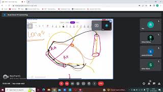 Pre Excitation syndromes  WPW amp LGL syndrome  ECG [upl. by Teena]