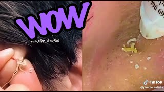 Top Satisfying Pimple Pops of 2024 Blackheads Cysts and More [upl. by Herzog]