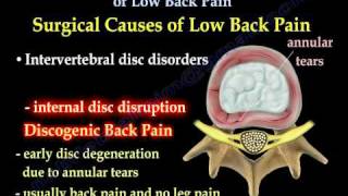 Low Back Painsciatica Disc surgery Everything You Need To Know  Dr Nabil Ebraheim [upl. by Shreve]